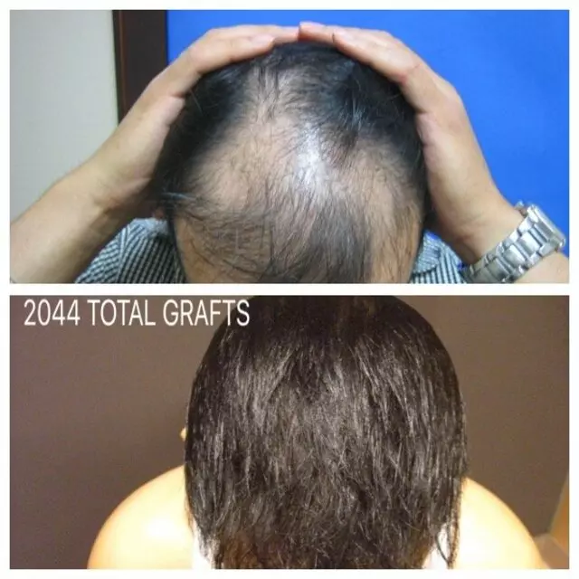 Advanced Medical Hair Institute